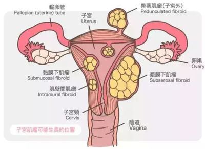 子宫肌瘤会影响怀孕和宝宝吗?