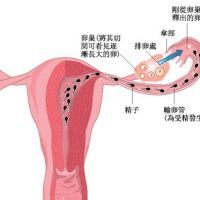 排卵功能障碍是什么?