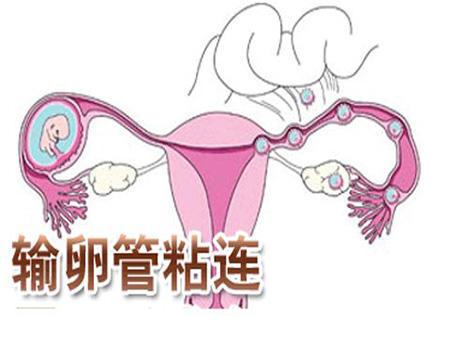 输卵管引起的不孕,原因除了堵塞外,还有这一高发疾病!