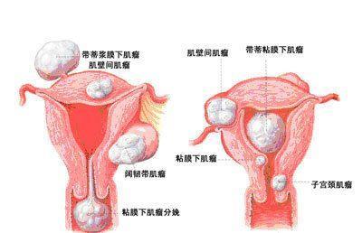 女性不孕症