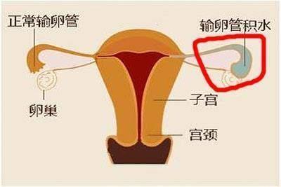 一直不孕?你的输卵管可还好?