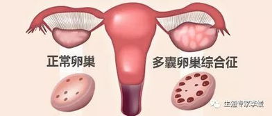 不孕症发病逐渐年轻化,年轻的女孩该如何预防