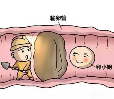 送子公公巧治输卵管梗阻不孕症
