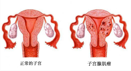 弥漫性和局限性的腺肌症哪个更严重?