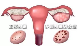 妇女闭经 多毛 肥胖会造成不孕症吗