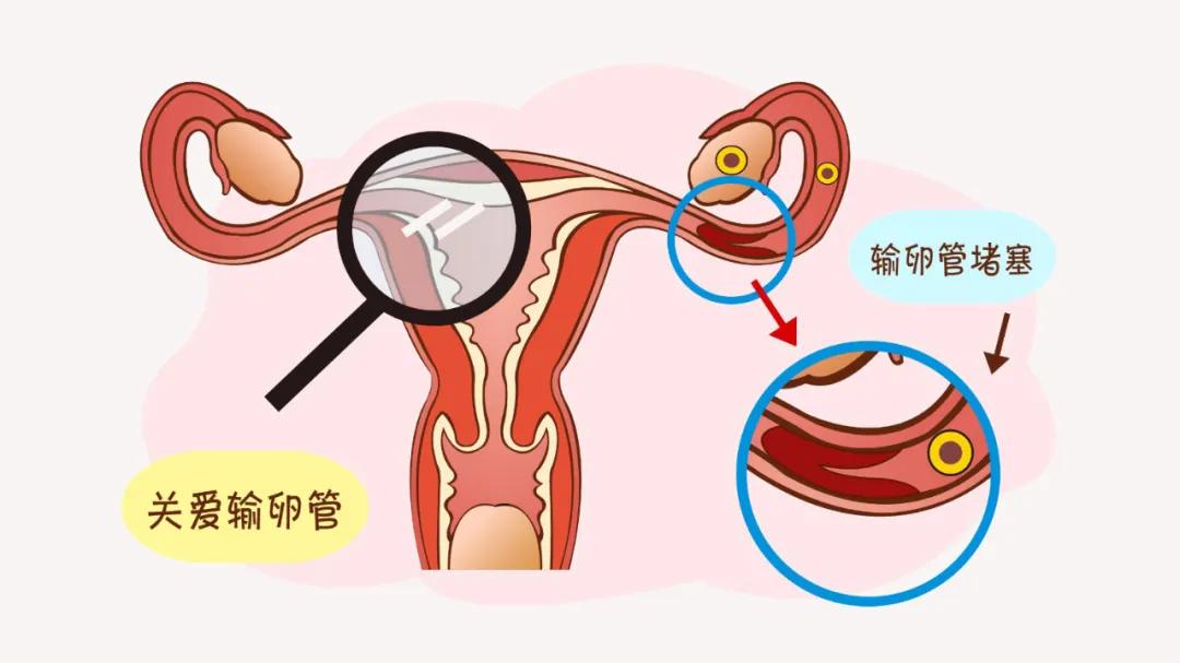 久备不孕 这5类人群一定要检查输卵管