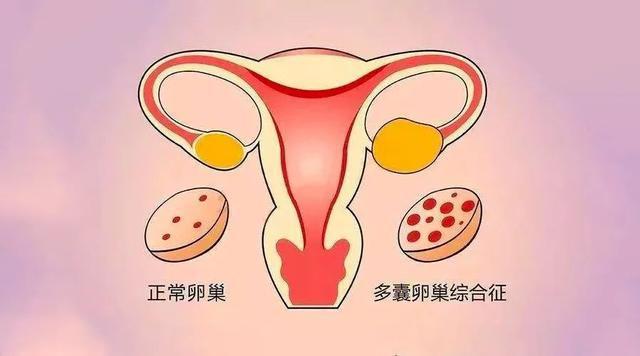 多囊卵巢