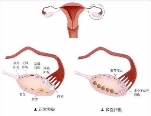 生育知识 预防卵巢性不孕,为了成功怀孕,值得一看