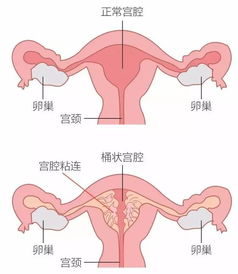 宫腔粘连的那点事 一
