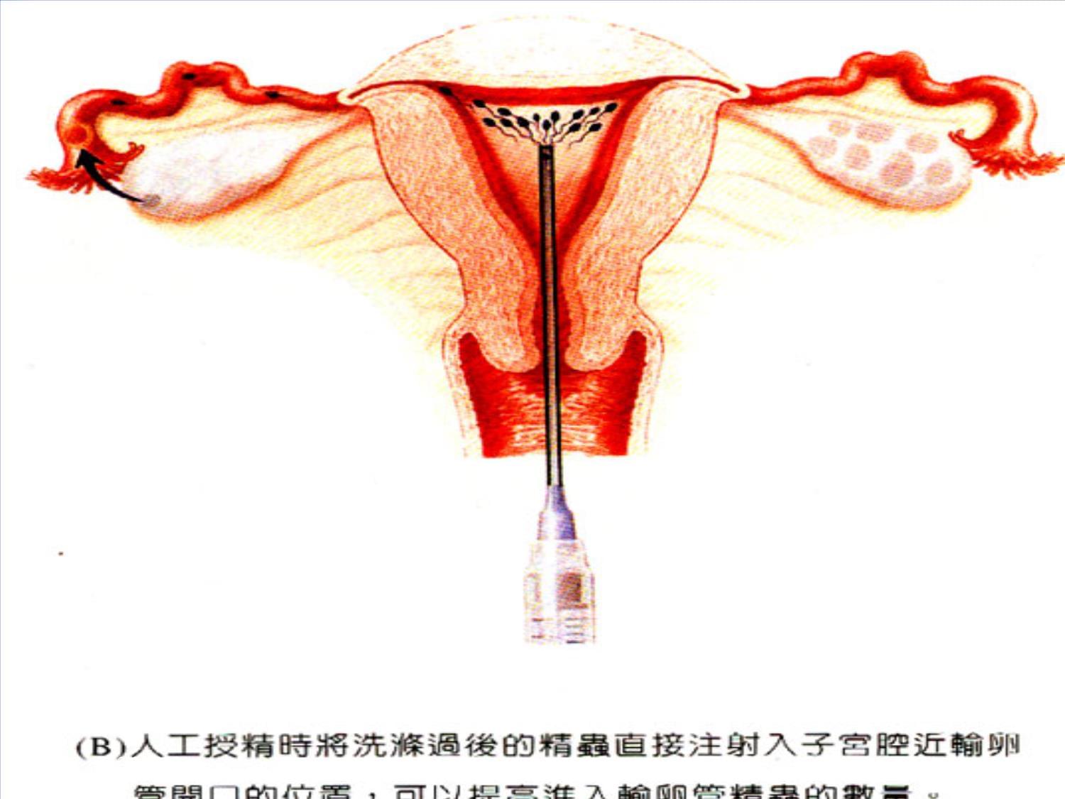 不孕症专题知识宣教