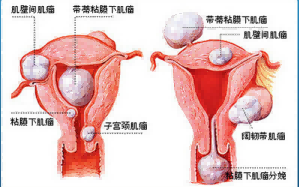 子宫肌瘤患者做试管婴儿,需要事先手术吗?