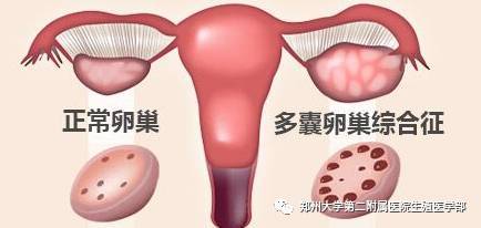 多囊卵巢综合征患者排卵障碍,怎么办?