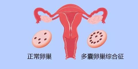 多囊=不孕?内分泌专家为您来支招