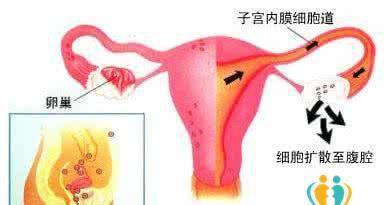 得了子宫内膜异位症,怎样才能顺利生娃?