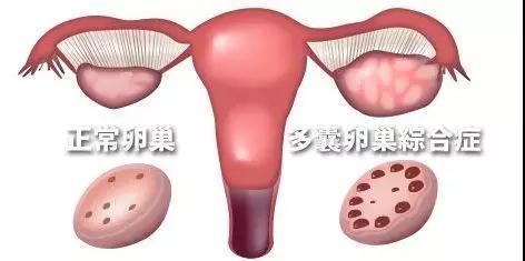 我属于多囊吗?一文看懂多囊卵巢综合征与不孕