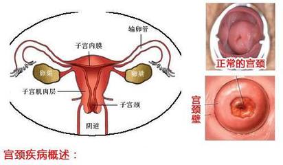 宫颈病变为什么会造成女性不孕?
