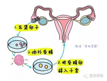 什么是试管婴儿?试管婴儿流程过程