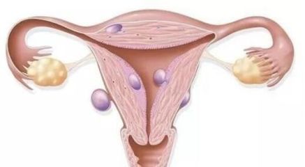 输卵管堵塞：手术疏通与试管婴儿的选择