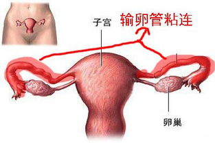 20余载技术锤炼，宫角输卵管植入术 不孕症的终结者