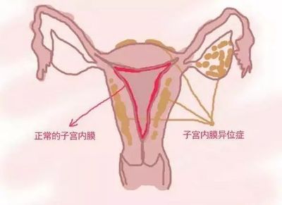 逃跑的内膜 不孕、月经失调与痛经的隐藏元凶
