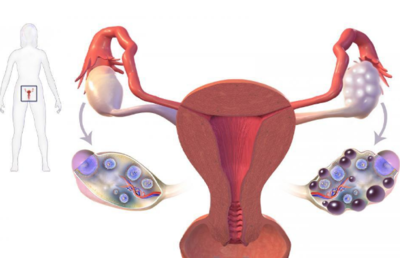 美国试管婴儿技术 科学助孕多囊卵巢综合征不孕症的新希望